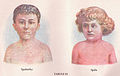Measles and Scarlet Fever (3796080398) cs.jpg